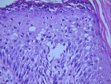 seborrheic dermatitis, spongiotic