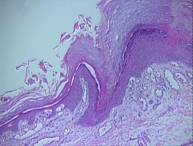 porokeratosis of Mibelli