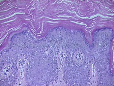lamellar ichthyosis