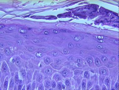 chronic dermatophytosis