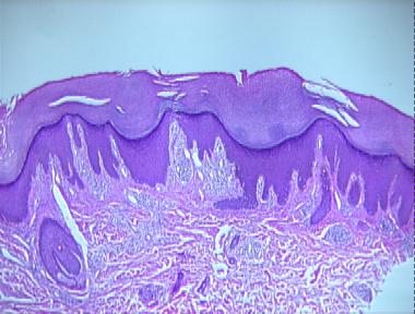 lichen simplex chronicus