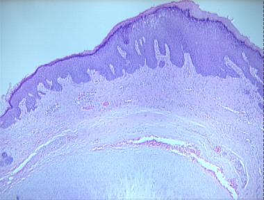 chondrodermatitis helicis nodularis