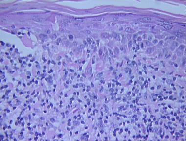 actinic keratosis, lichenoid type