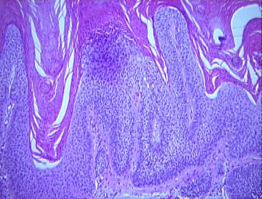 hyperplastic actinic keratosis