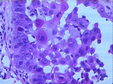 squamous cell carcinoma, pseudoglandular type