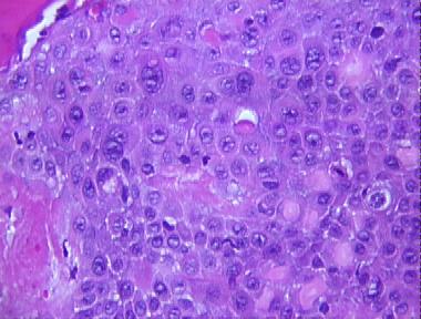 squamous cell carcinoma in situ