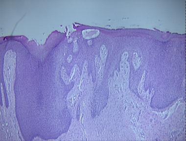 pseudocarcinomatous hyperplasia