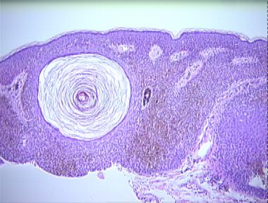 melanoacanthoma (pigmented seborrheic keratosis)