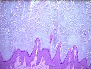 acrokeratosis verruciformis of Hopf