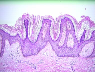 acanthosis nigricans