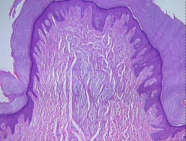 supernumerary digit with amputated neuroma