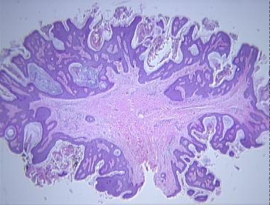 acrochordon (fibroepithelial polyp, skin tag)