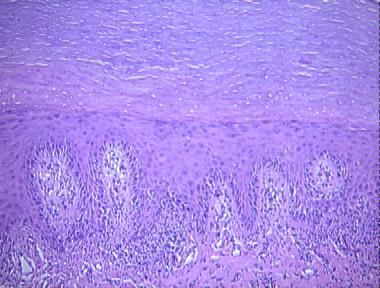 atypical leukokeratosis (histologic leukoplakia)