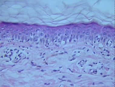 erythema dyschromicum perstans (Ashy dermatosis)
