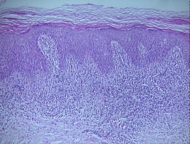 lichen planus-like keratosis