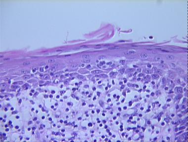 mycosis fungoides, patch stage