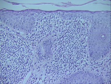 keratosis lichenoides chronica