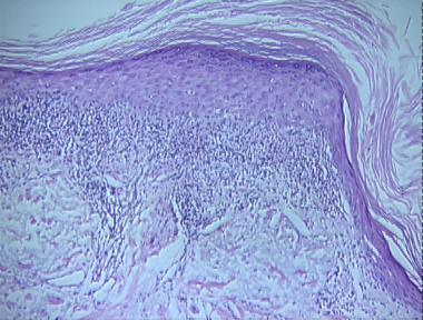 lichenoid discoid lupus erythematosus