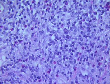 mycosis fungoides, plaque stage