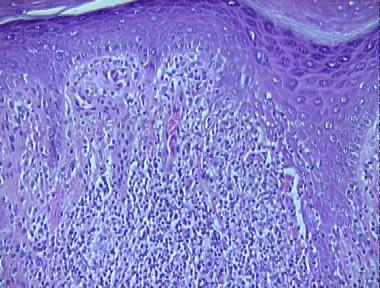 secondary syphilis, lichenoid