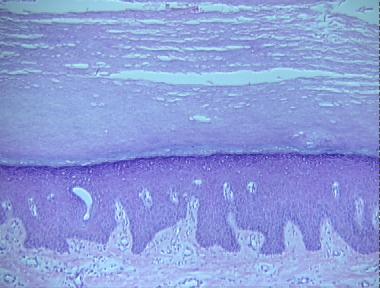 keratosis palmaris et plantaris