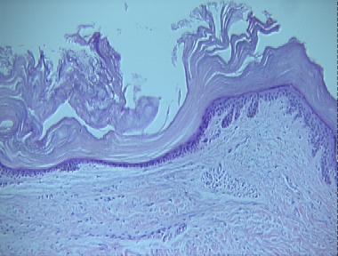 hyperkeratosis lenticularis perstans (Flegel's disease)