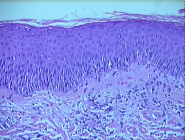 acute dermatophytosis