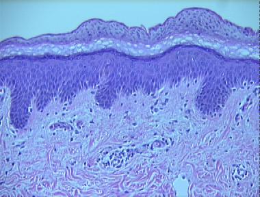 guttate parapsoriasis (digitate dermatosis)