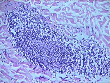 lymphocytic infiltration of Jessner