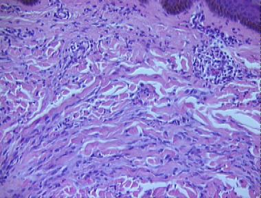 scleromyxedema