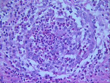 allergic granulomatosis (Churg and Straus)