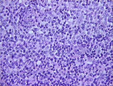 lymphocytoma cutis (Spiegler-Fendt sarcoid)