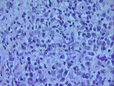 mycosis fungoides, tumor stage