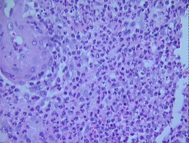 pyoderma gangrenosum