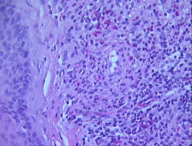 granuloma faciale
