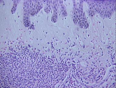 Sweet's syndrome (acute febrile neutrophilic dermatosis)