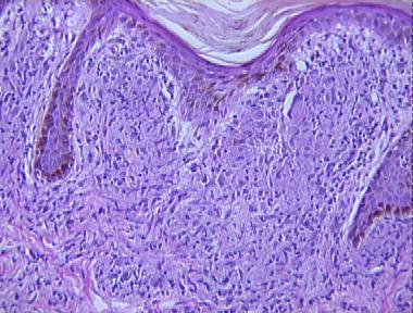 dimorphous leprosy
