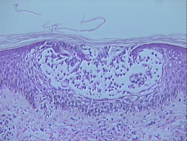 acute allergic contact dermatitis