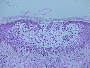 acute allergic contact dermatitis