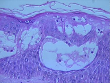 acute irritant contact dermatitis
