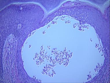 vesicular dermatophytosis