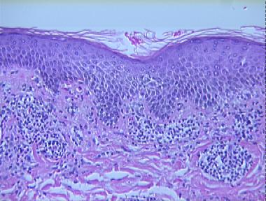 erythema annulare centrifugum