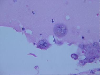 herpes virus infection