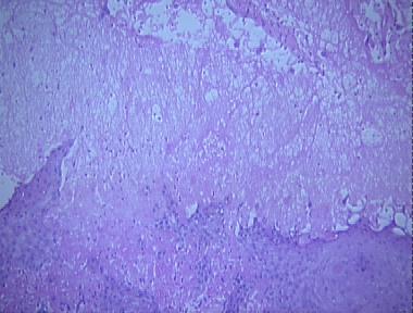 milker's nodule/orf