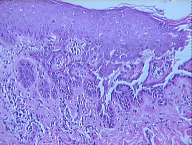 Grover's disease (Transient acantholytic dermatosis)