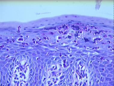 acute candidiasis