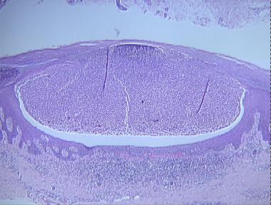 pustulosis palmaris et plantaris (dermatitis repens)