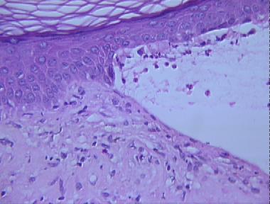 cicatricial pemphigoid (benign mucous membrane pemphigoid)