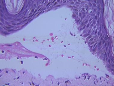 bullous pemphigoid, cell-poor type