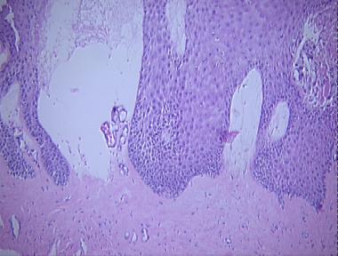 bullous scleroderma